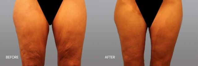Thigh Lift result at North Texas Plastic Surgery in Dallas, TX