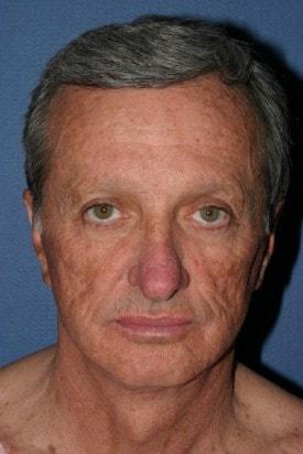 Fat Transfer before at Dr. Andrew M. Wolin: Plastic Surgeon Scottsdale in Scottsdale, AZ