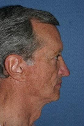 Fat Transfer before at Dr. Andrew M. Wolin: Plastic Surgeon Scottsdale in Scottsdale, AZ