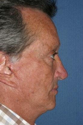 Fat Transfer after at Dr. Andrew M. Wolin: Plastic Surgeon Scottsdale in Scottsdale, AZ