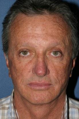 Fat Transfer after at Dr. Andrew M. Wolin: Plastic Surgeon Scottsdale in Scottsdale, AZ