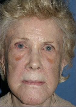 Fat Transfer before at Dr. Andrew M. Wolin: Plastic Surgeon Scottsdale in Scottsdale, AZ