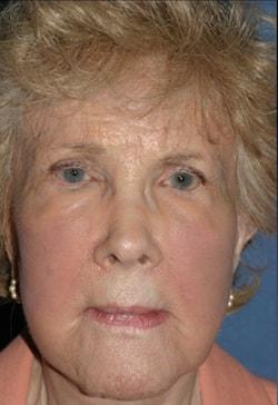 Fat Transfer after at Dr. Andrew M. Wolin: Plastic Surgeon Scottsdale in Scottsdale, AZ