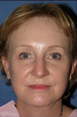 Fat Transfer after at Dr. Andrew M. Wolin: Plastic Surgeon Scottsdale in Scottsdale, AZ