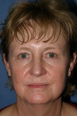Fat Transfer before at Dr. Andrew M. Wolin: Plastic Surgeon Scottsdale in Scottsdale, AZ