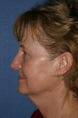 Fat Transfer before at Dr. Andrew M. Wolin: Plastic Surgeon Scottsdale in Scottsdale, AZ
