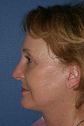 Fat Transfer after at Dr. Andrew M. Wolin: Plastic Surgeon Scottsdale in Scottsdale, AZ