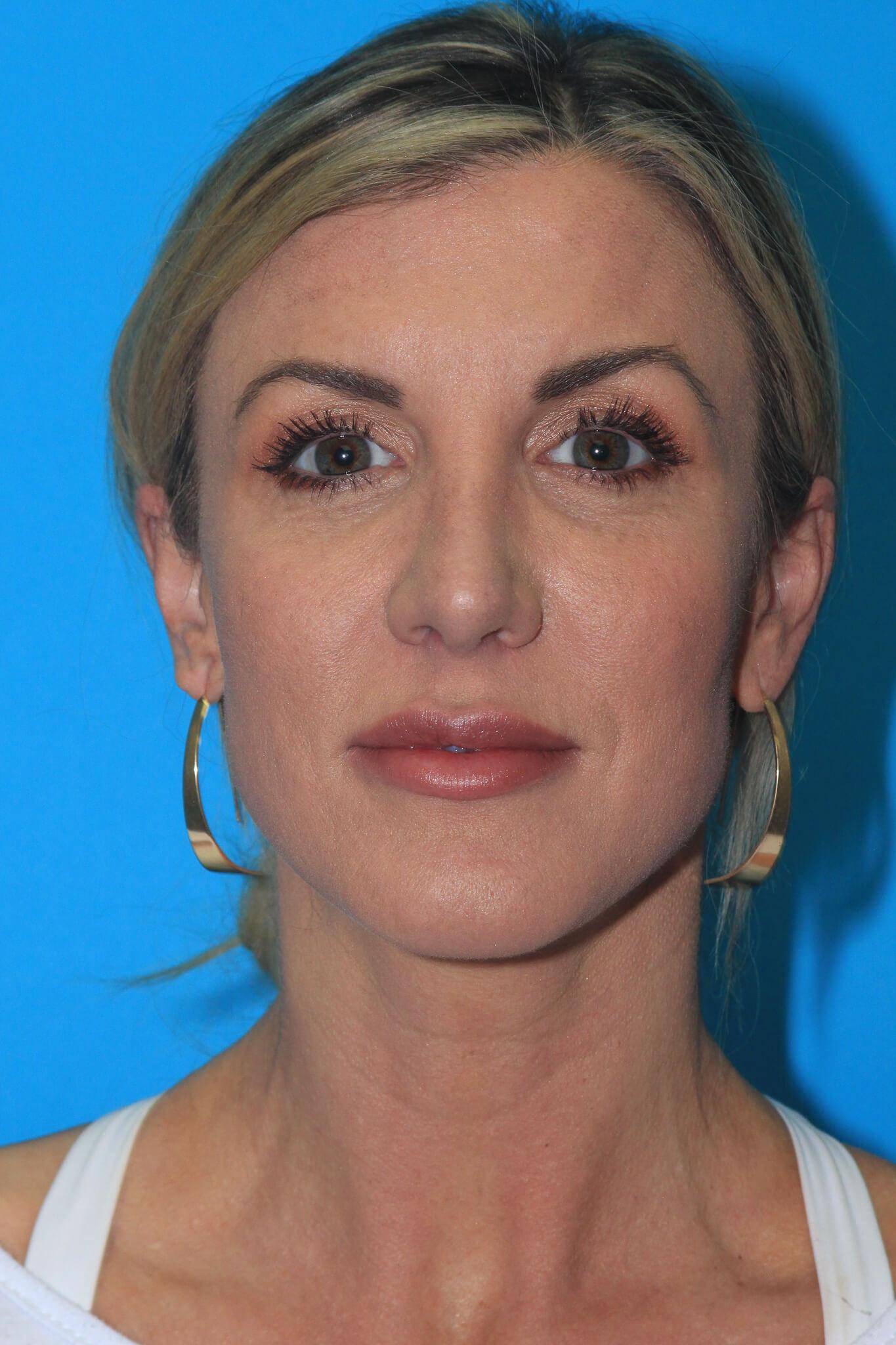 Dr. Andrew M. Wolin: Plastic Surgeon Scottsdale after — Scottsdale, AZ