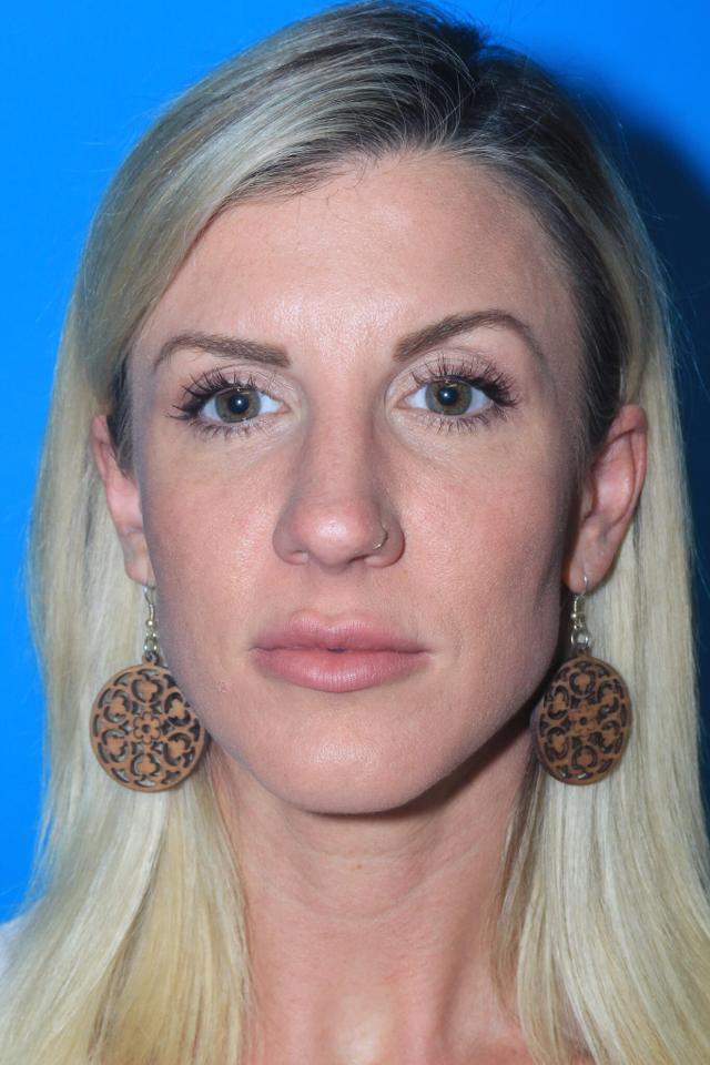 Functional Rhinoplasty before at Dr. Andrew M. Wolin: Plastic Surgeon Scottsdale in Scottsdale, AZ