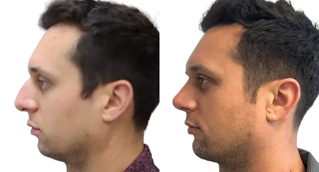 Chin Implant result at Giriraj K. Sharma, MD - Facial Plastic Surgery in Newport Beach, CA