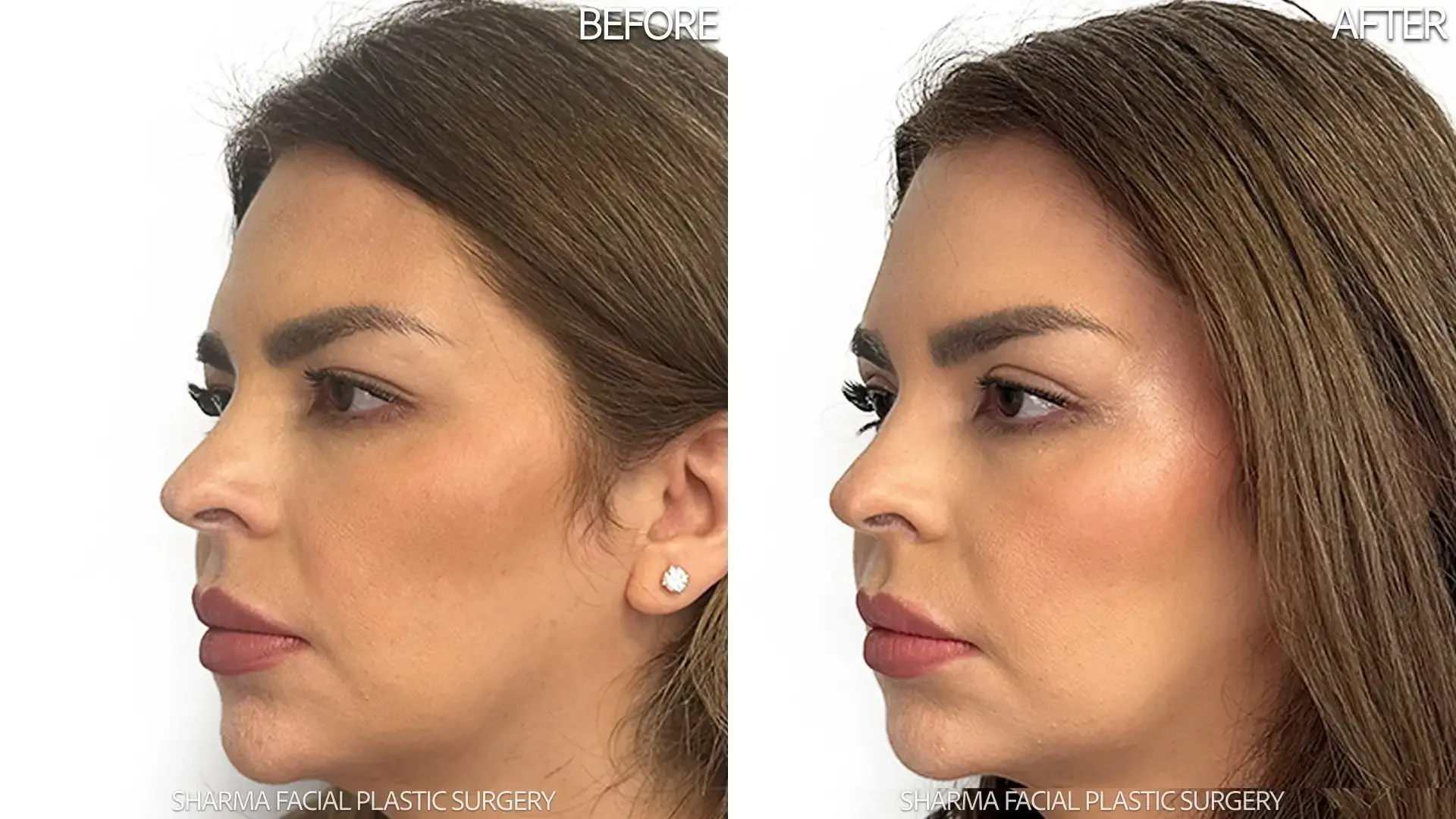 Giriraj K. Sharma, MD - Facial Plastic Surgery brow lift result — Newport Beach, CA
