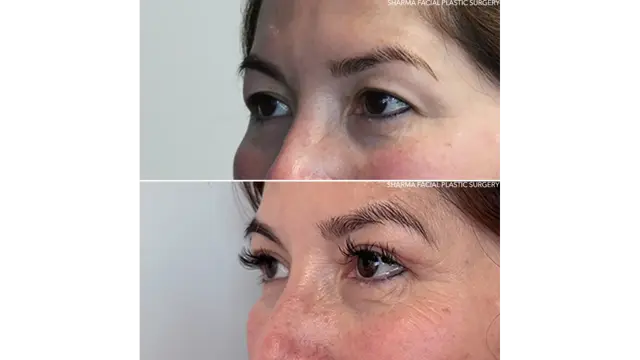 Blepharoplasty result at Giriraj K. Sharma, MD - Facial Plastic Surgery in Newport Beach, CA