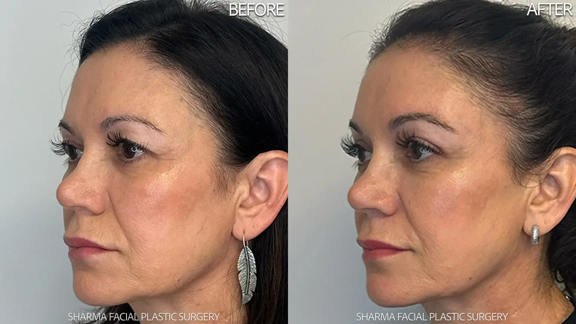 Giriraj K. Sharma, MD - Facial Plastic Surgery brow lift result — Newport Beach, CA