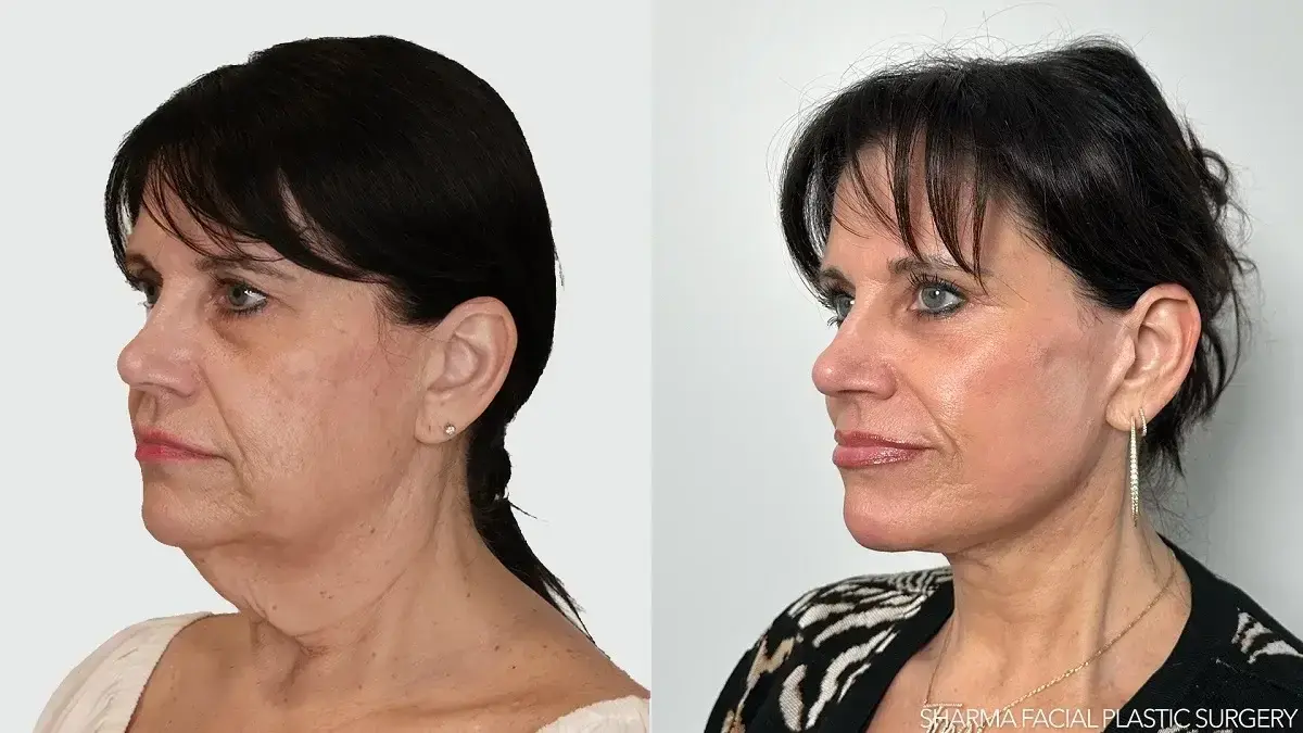 Giriraj K. Sharma, MD - Facial Plastic Surgery facelift result — Newport Beach, CA