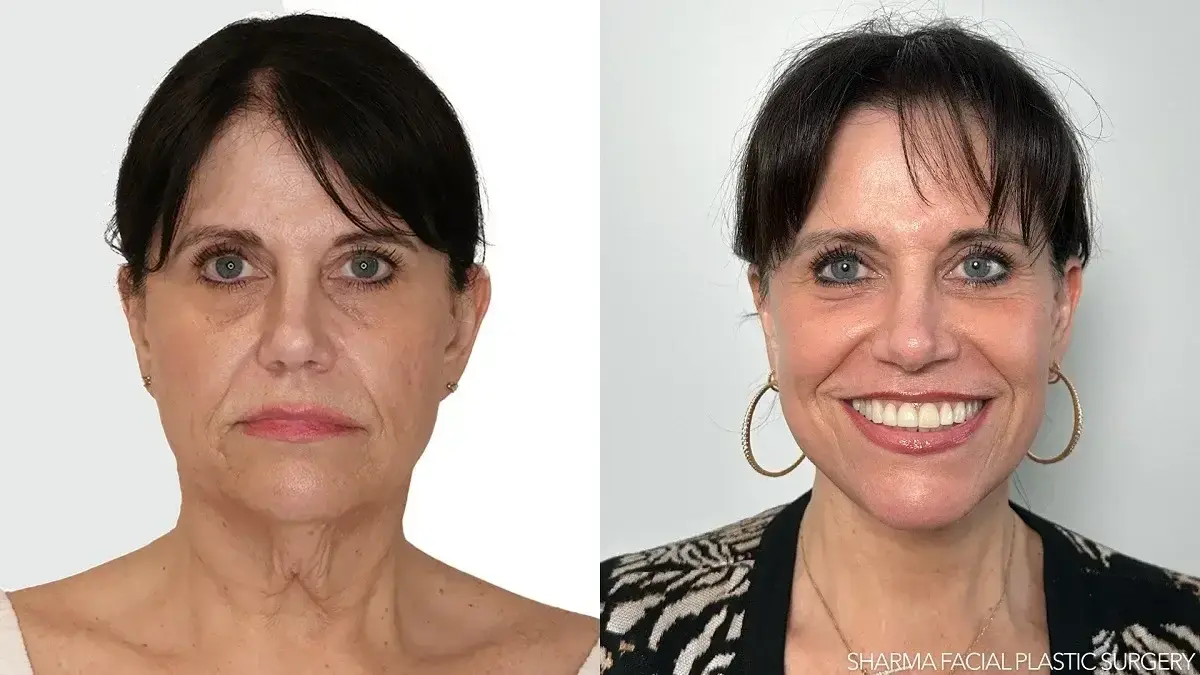 Giriraj K. Sharma, MD - Facial Plastic Surgery facelift result — Newport Beach, CA