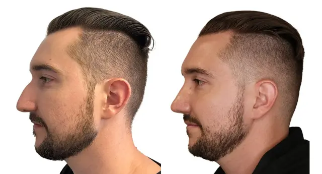 Rhinoplasty result at Giriraj K. Sharma, MD - Facial Plastic Surgery in Newport Beach, CA