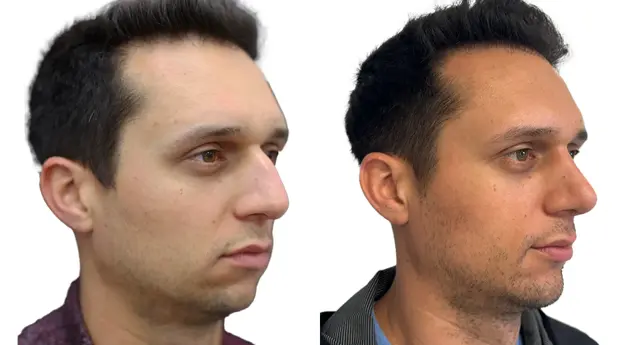 Chin Implant result at Giriraj K. Sharma, MD - Facial Plastic Surgery in Newport Beach, CA