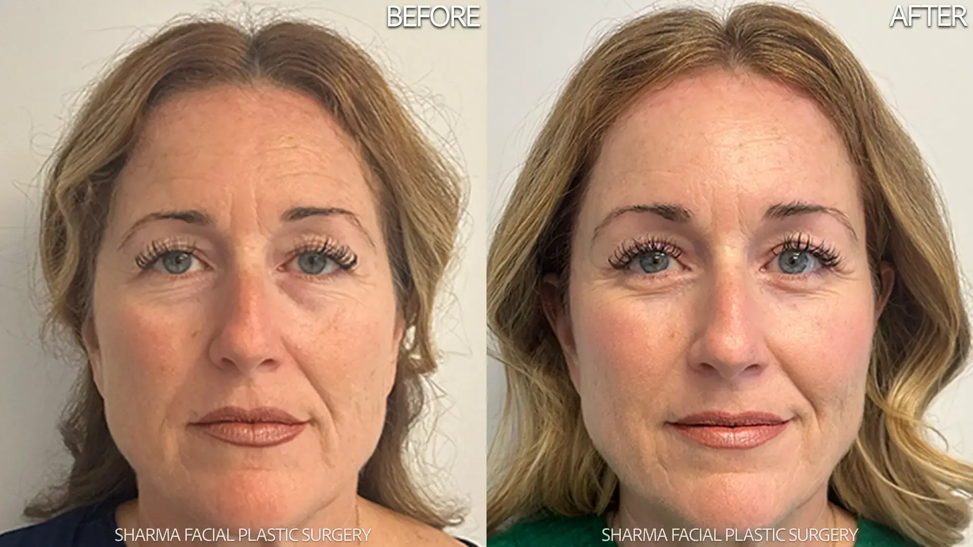 Giriraj K. Sharma, MD - Facial Plastic Surgery brow lift result — Newport Beach, CA