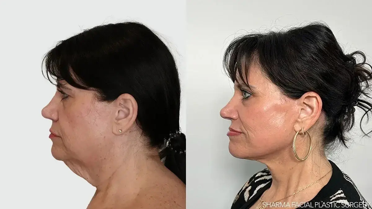 Giriraj K. Sharma, MD - Facial Plastic Surgery facelift result — Newport Beach, CA
