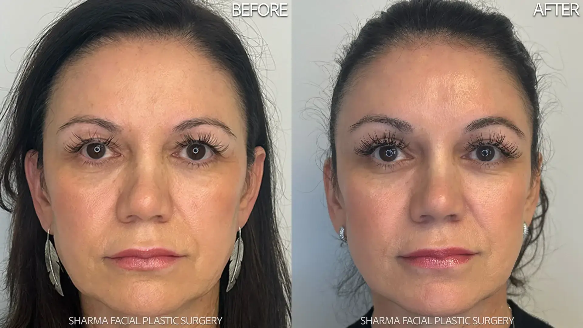 Giriraj K. Sharma, MD - Facial Plastic Surgery brow lift result — Newport Beach, CA