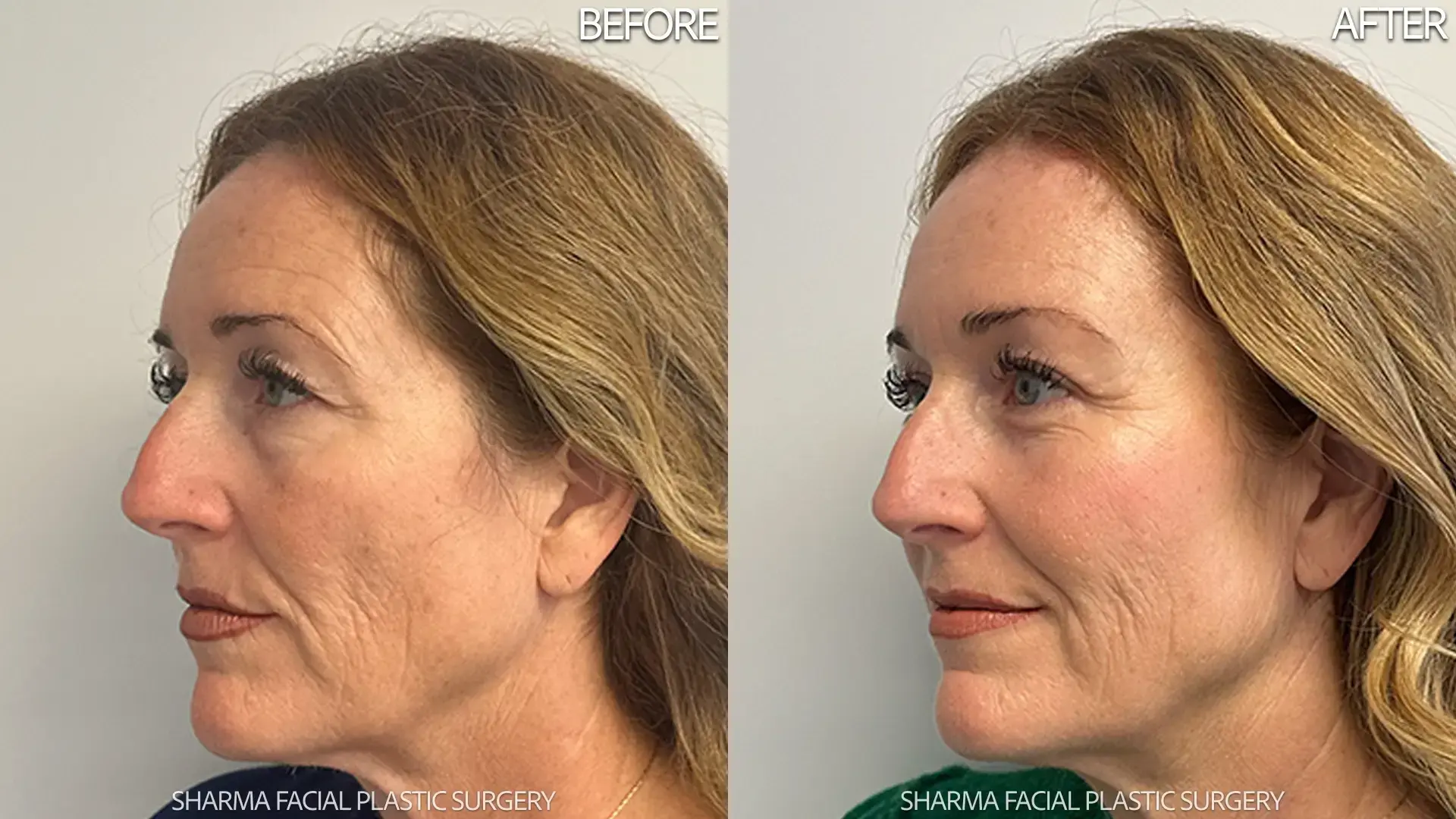 Giriraj K. Sharma, MD - Facial Plastic Surgery brow lift result — Newport Beach, CA