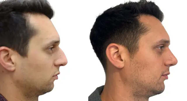 Chin Implant result at Giriraj K. Sharma, MD - Facial Plastic Surgery in Newport Beach, CA