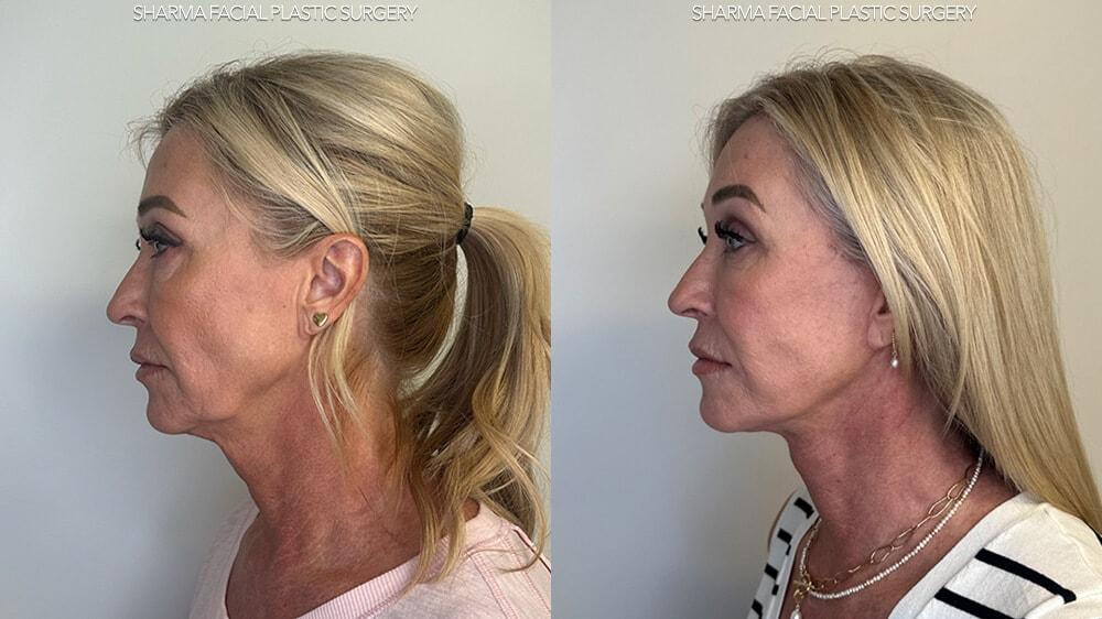 Giriraj K. Sharma, MD - Facial Plastic Surgery facelift result — Newport Beach, CA