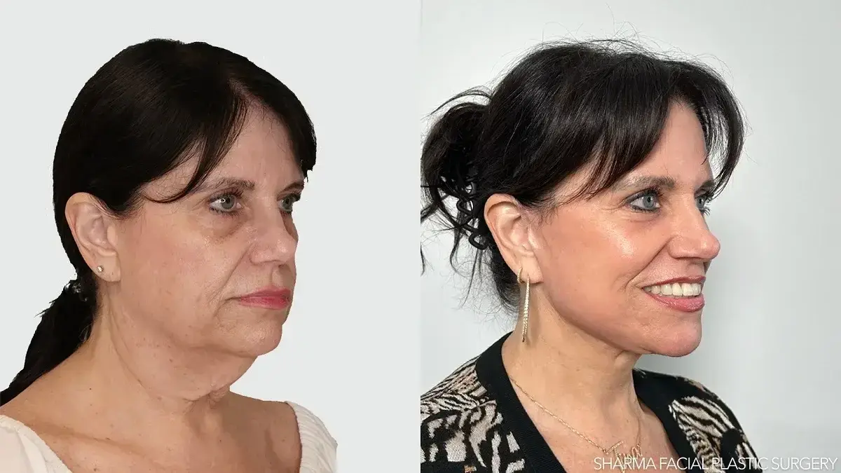 Giriraj K. Sharma, MD - Facial Plastic Surgery facelift result — Newport Beach, CA