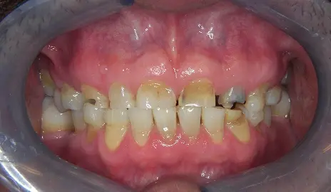 Smile Makeover before at Dentistry of Old Town Scottsdale in Scottsdale, AZ
