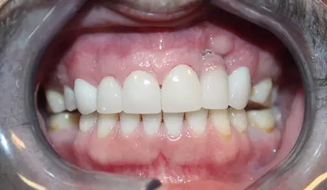 Dentistry of Old Town Scottsdale smile makeover after — Scottsdale, AZ