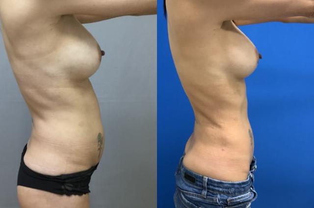 Liposuction result at Dr. Hisham M. Seify, MD,PhD in Newport Beach, CA