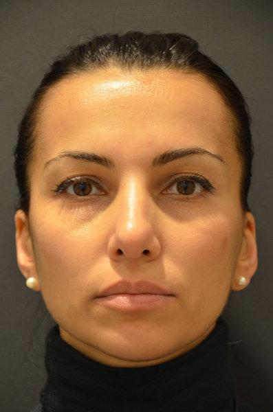 Preminger Plastic Surgery otoplasty after — New York, NY