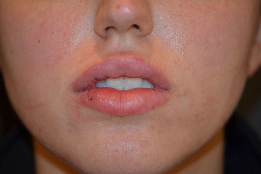 Preminger Plastic Surgery facelift after — New York, NY