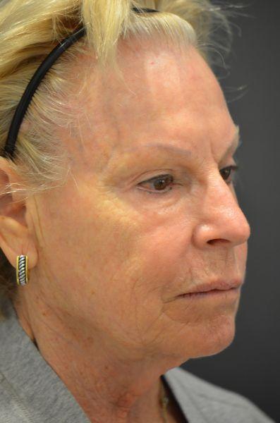 Facelift after at Preminger Plastic Surgery in New York, NY