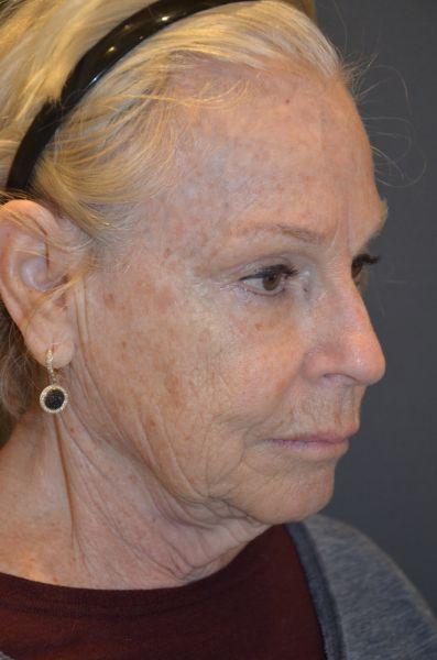 Facelift before at Preminger Plastic Surgery in New York, NY