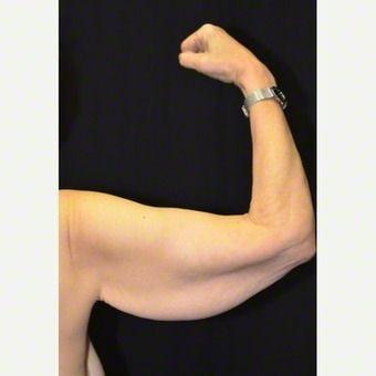 Arm Lift before at Preminger Plastic Surgery in New York, NY