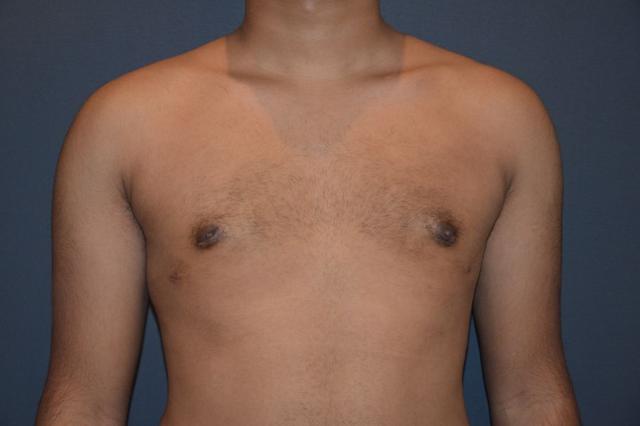 Gynecomastia Surgery after at Preminger Plastic Surgery in New York, NY