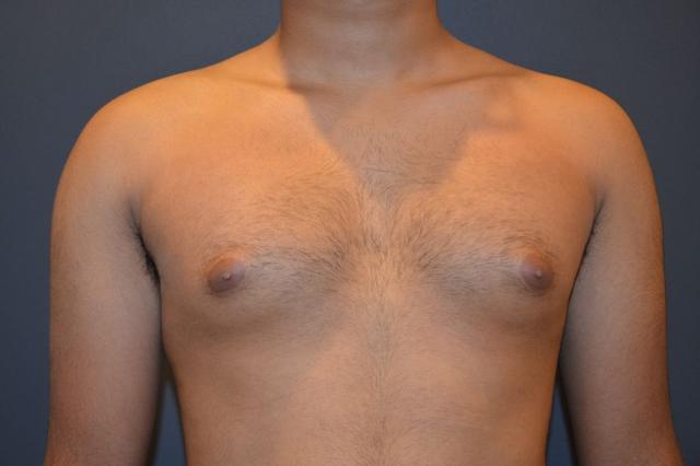 Gynecomastia Surgery before at Preminger Plastic Surgery in New York, NY