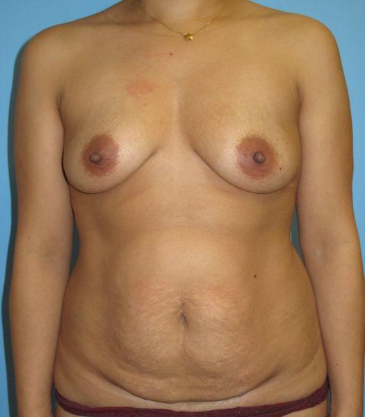 Breast Augmentation before at Preminger Plastic Surgery in New York, NY