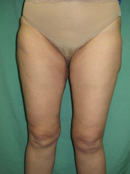 Preminger Plastic Surgery otoplasty after — New York, NY