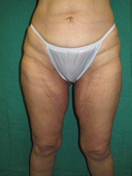 Thigh Lift before at Preminger Plastic Surgery in New York, NY