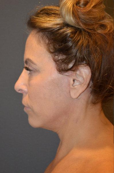 Neck Lift after at Preminger Plastic Surgery in New York, NY