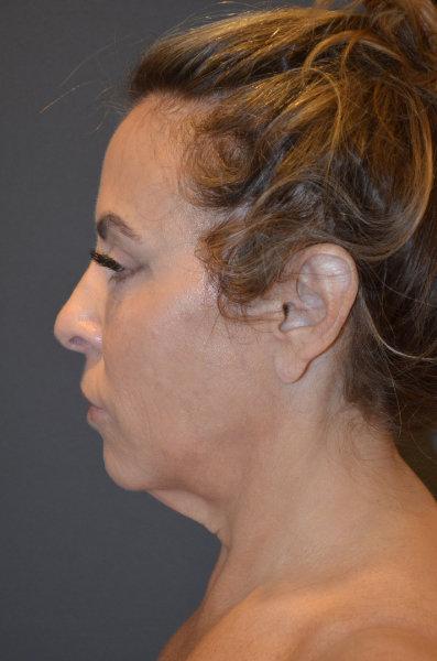 Neck Lift before at Preminger Plastic Surgery in New York, NY