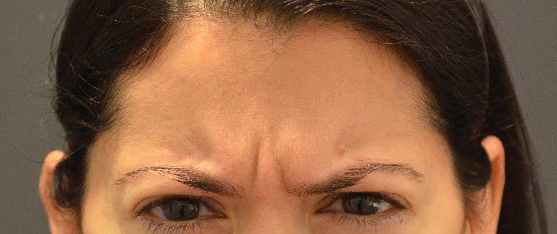 Preminger Plastic Surgery botox result — New York, NY
