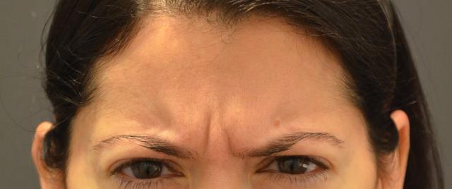 Botox result at Preminger Plastic Surgery in New York, NY