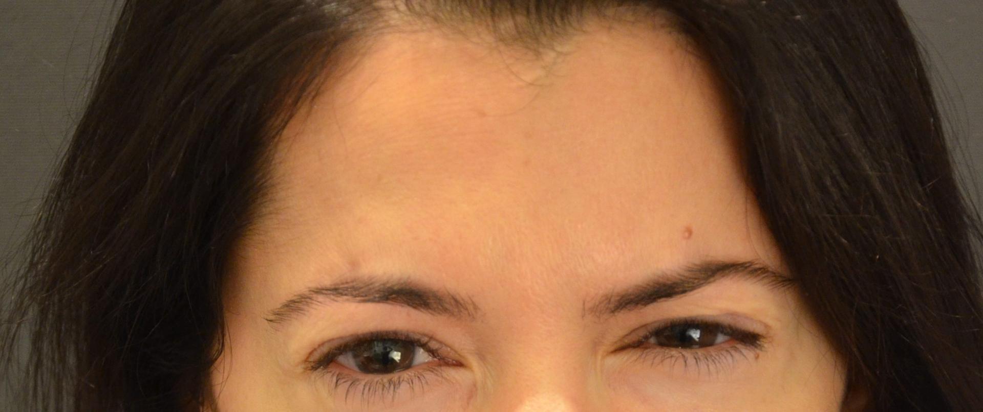 Preminger Plastic Surgery botox result — New York, NY