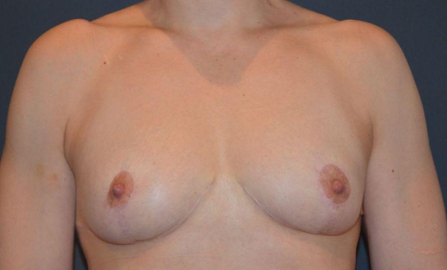 Preminger Plastic Surgery breast reduction after — New York, NY