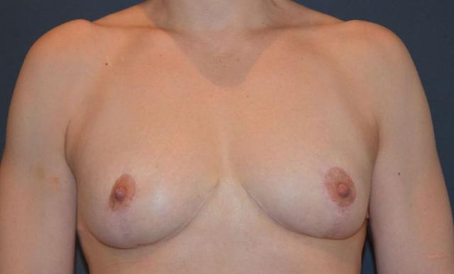 Breast Reduction after at Preminger Plastic Surgery in New York, NY