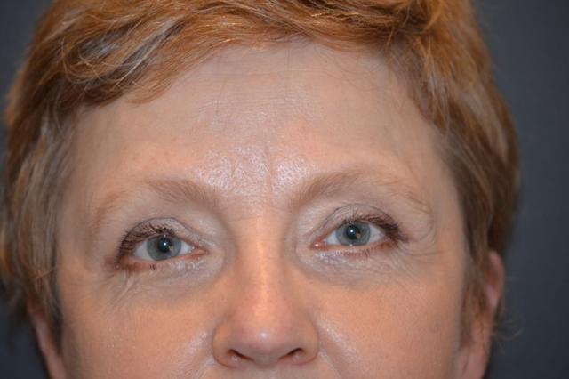 Blepharoplasty after at Preminger Plastic Surgery in New York, NY