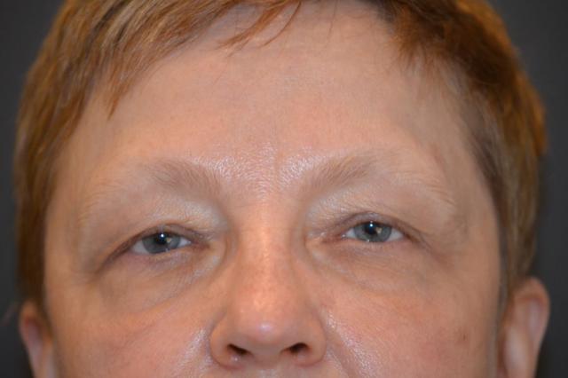 Blepharoplasty before at Preminger Plastic Surgery in New York, NY